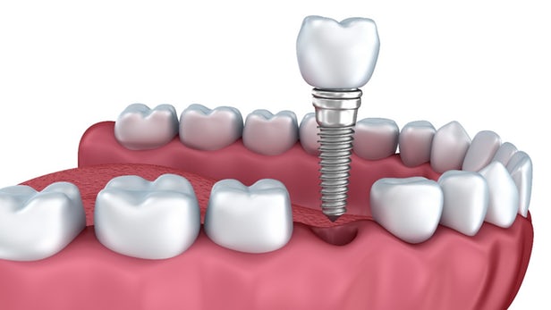 Những câu hỏi thường gặp về cấy ghép Implant